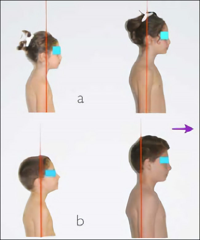 Can the Treatment of Dental Malocclusions Affect the Posture in Children